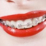 aparat-ortodontyczny-moda-na-piekny-i-zdrowy-usmiech-kobietawielepiej-pl
