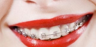 aparat-ortodontyczny-moda-na-piekny-i-zdrowy-usmiech-kobietawielepiej-pl