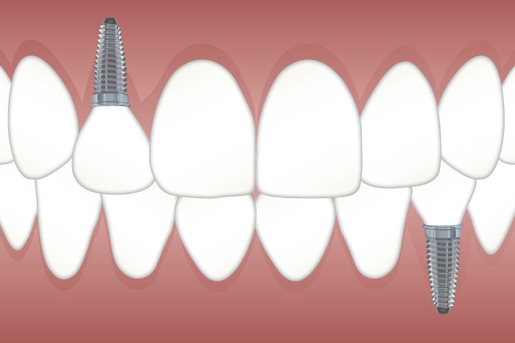 Implanty dentystyczne, jako popularny rodzaj stałych protez zębowych.