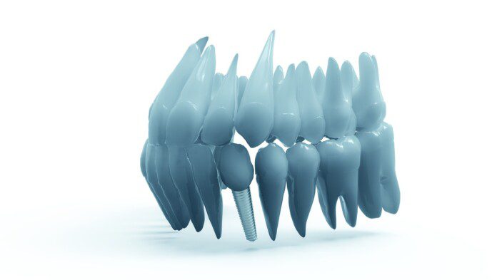 Implanty dentystyczne, jako popularny rodzaj stałych protez zębowych.