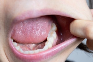 Zakażenie jamy ustnej u dzieci – jak zapobiegać i leczyć?