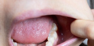 Zakażenie jamy ustnej u dzieci – jak zapobiegać i leczyć?