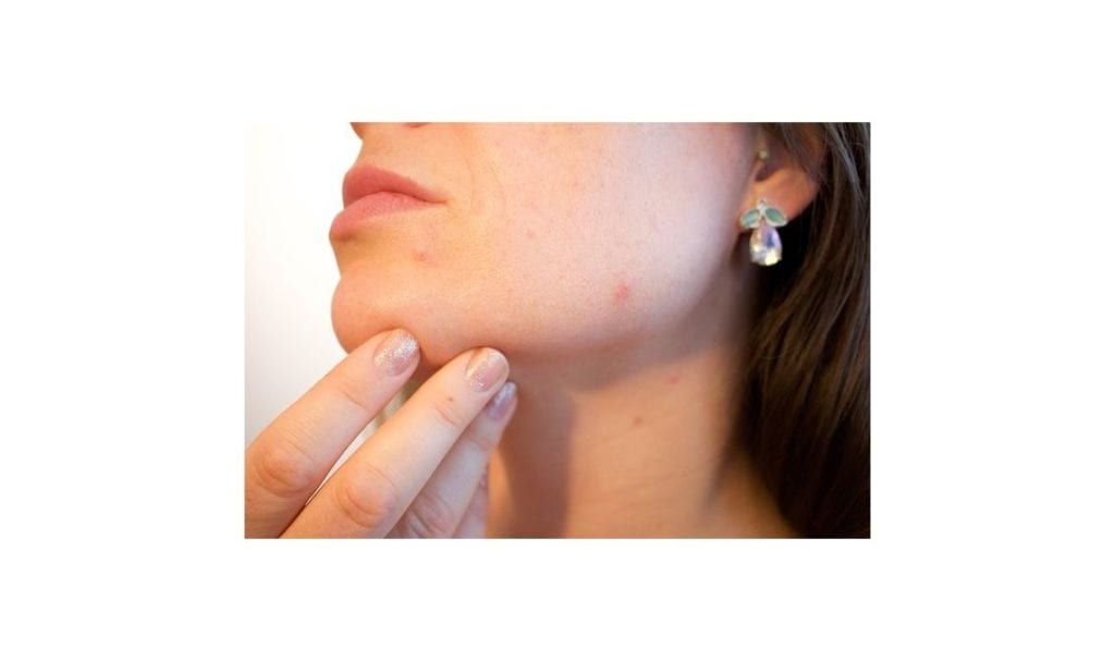 Czym jest peeling kawitacyjny i jakie korzyści daje? - Kobieta Wie Lepiej.pl acne 1606765 640 1